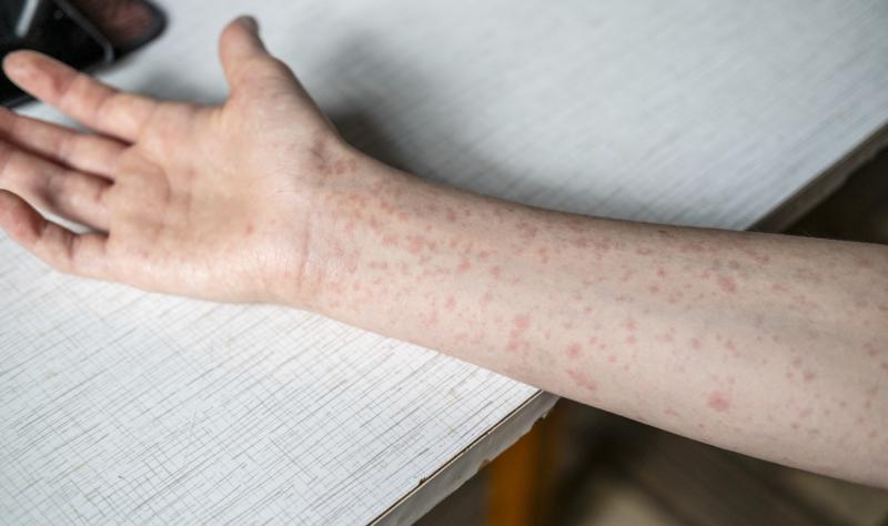 Plague News: Bird Flu, COVID, Measles - 4.15.25