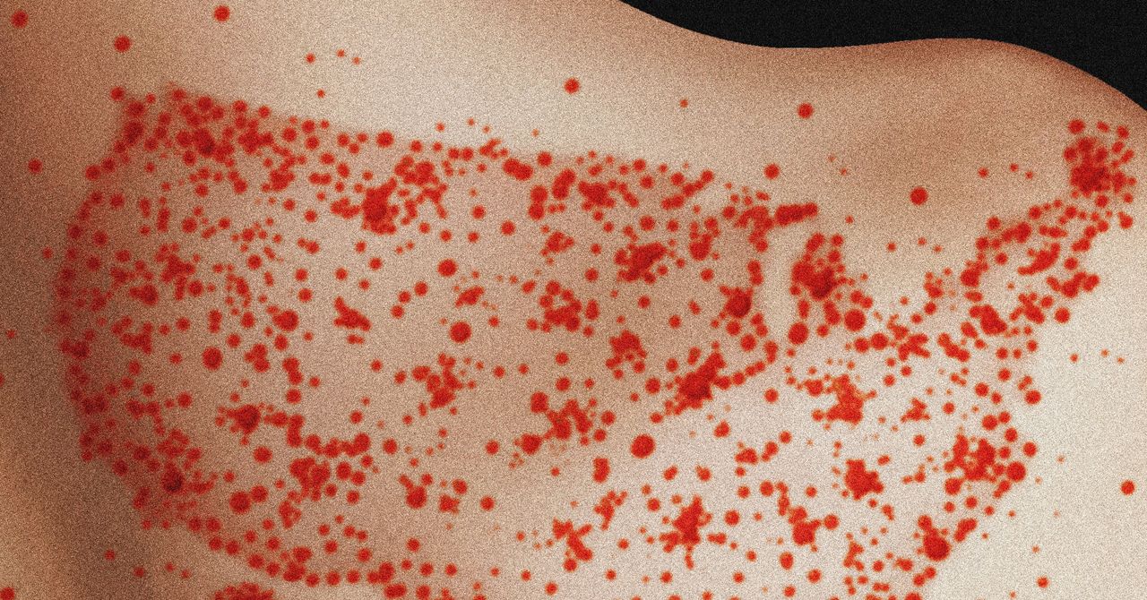 Plague News: Bird Flu, COVID, Measles, Good News - 5.8.25